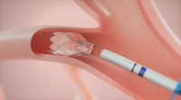 O hospital de Vigo implanta un novo procedemento endoscópico nos pulmóns