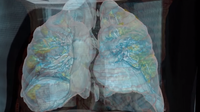 Un vídeo amosa os danos que causa o coronavirus nos pulmóns